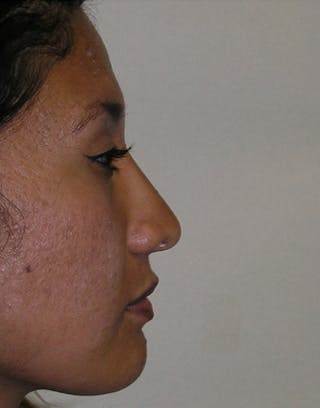 Rhinoplasty Before & After Gallery - Patient 412234 - Image 2