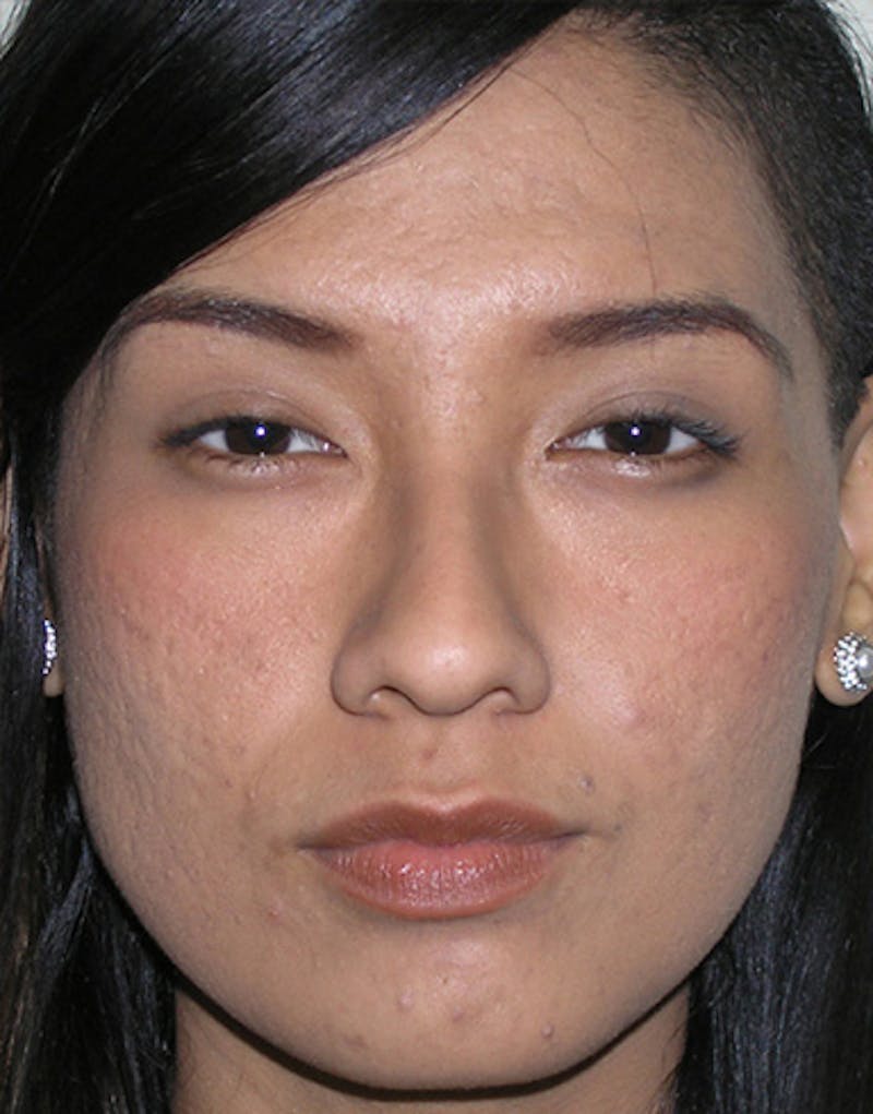 Ethnic Rhinoplasty Before & After Gallery - Patient 244978 - Image 3