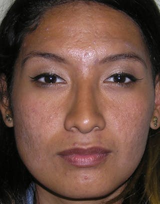 Rhinoplasty Before & After Gallery - Patient 412234 - Image 4