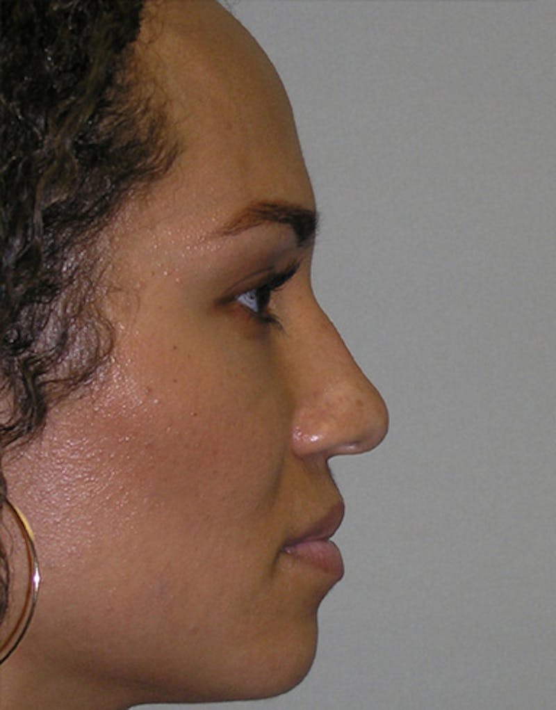 Patient UV2j8-umTrCchx0Iq5PePg - Ethnic Rhinoplasty Before & After Photos