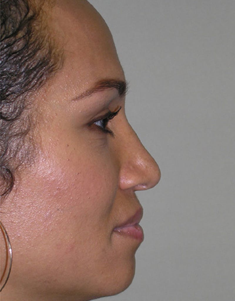 Ethnic Rhinoplasty Before & After Gallery - Patient 159336 - Image 4