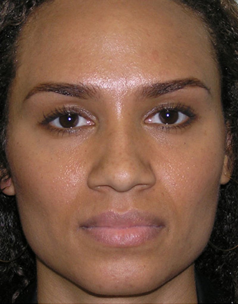 Ethnic Rhinoplasty Before & After Gallery - Patient 159336 - Image 5