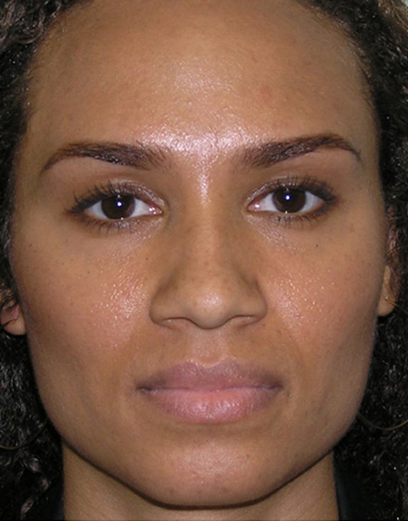 Rhinoplasty  Before & After Gallery - Patient 327997 - Image 5