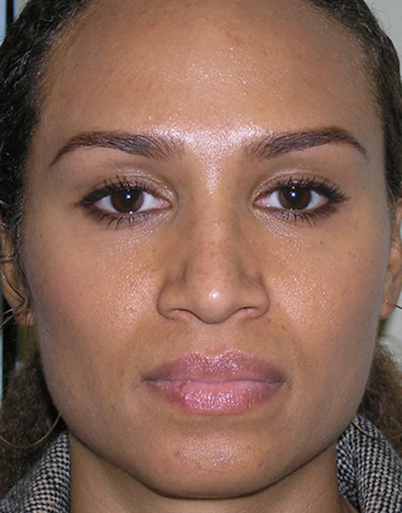 Ethnic Rhinoplasty Before & After Gallery - Patient 159336 - Image 6