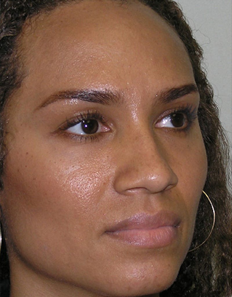Ethnic Rhinoplasty Before & After Gallery - Patient 159336 - Image 7