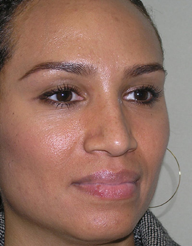 Ethnic Rhinoplasty Before & After Gallery - Patient 159336 - Image 8