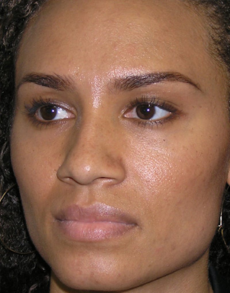 Ethnic Rhinoplasty Before & After Gallery - Patient 159336 - Image 1