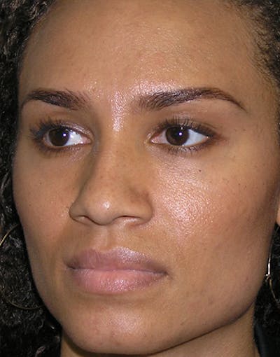 Rhinoplasty Before & After Gallery - Patient 327997 - Image 1