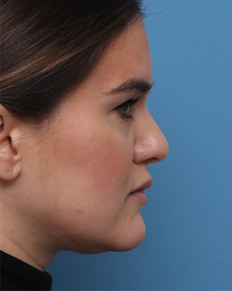 Rhinoplasty Before & After Gallery - Patient 222405 - Image 3