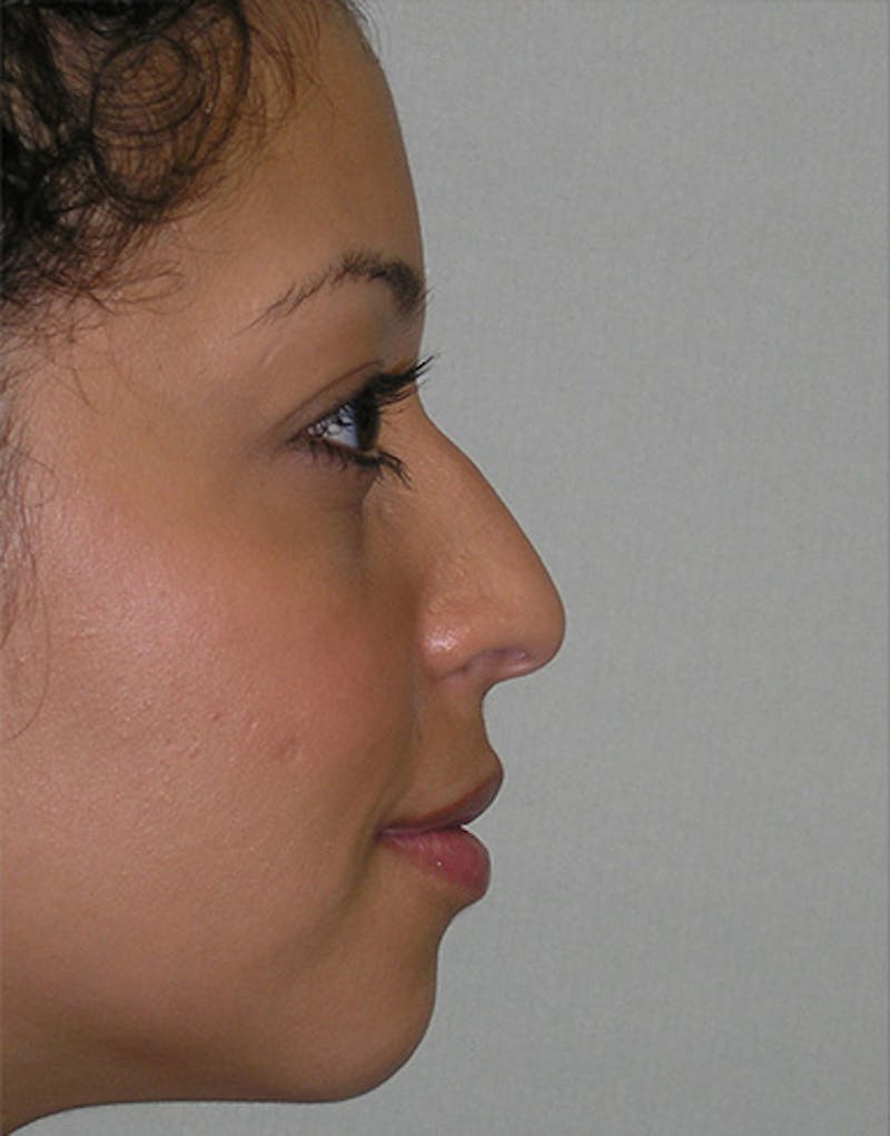 Patient XkWOkB17Sd-APfmltw9LLA - Ethnic Rhinoplasty Before & After Photos