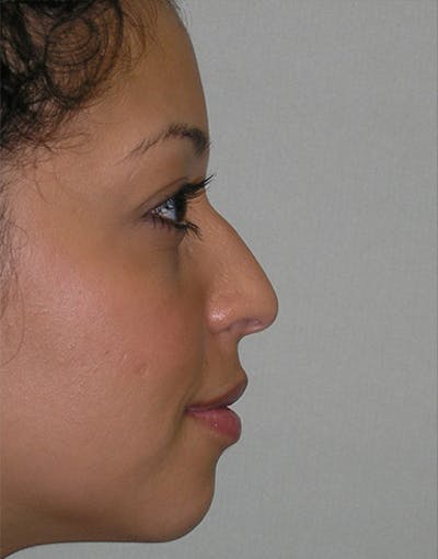 Rhinoplasty Before & After Gallery - Patient 156471 - Image 1