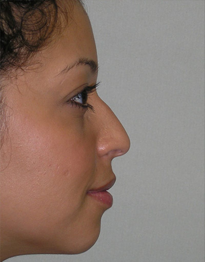 Ethnic Rhinoplasty Before & After Gallery - Patient 202623 - Image 1
