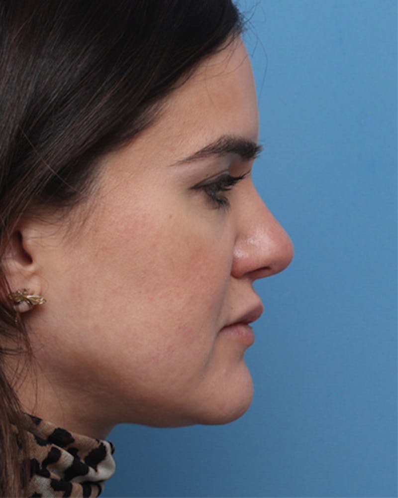 Rhinoplasty Before & After Gallery - Patient 222405 - Image 4