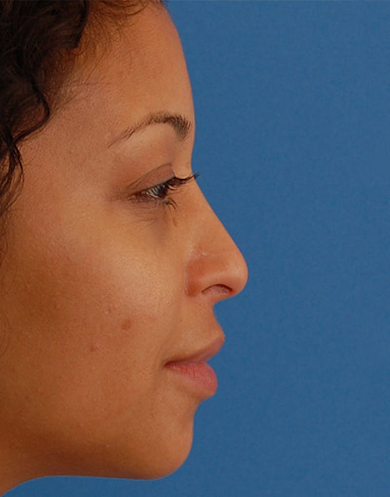 Ethnic Rhinoplasty Before & After Gallery - Patient 202623 - Image 2