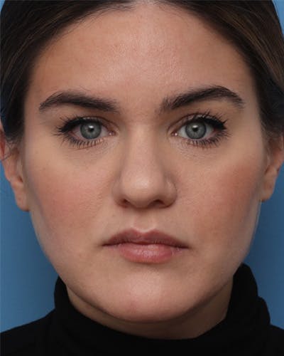 Rhinoplasty Before & After Gallery - Patient 542837 - Image 1