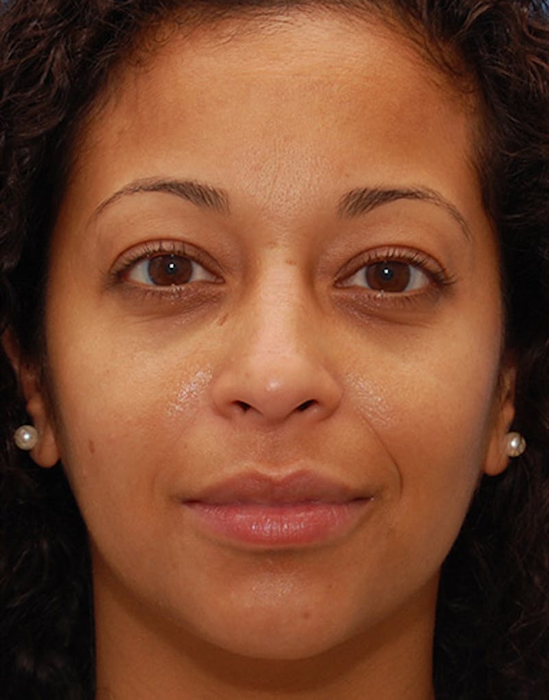 Ethnic Rhinoplasty Before & After Gallery - Patient 202623 - Image 4