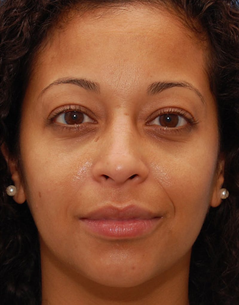 Rhinoplasty  Before & After Gallery - Patient 156471 - Image 4