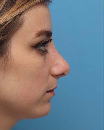 Rhinoplasty Before & After Gallery - Patient 121265 - Image 1