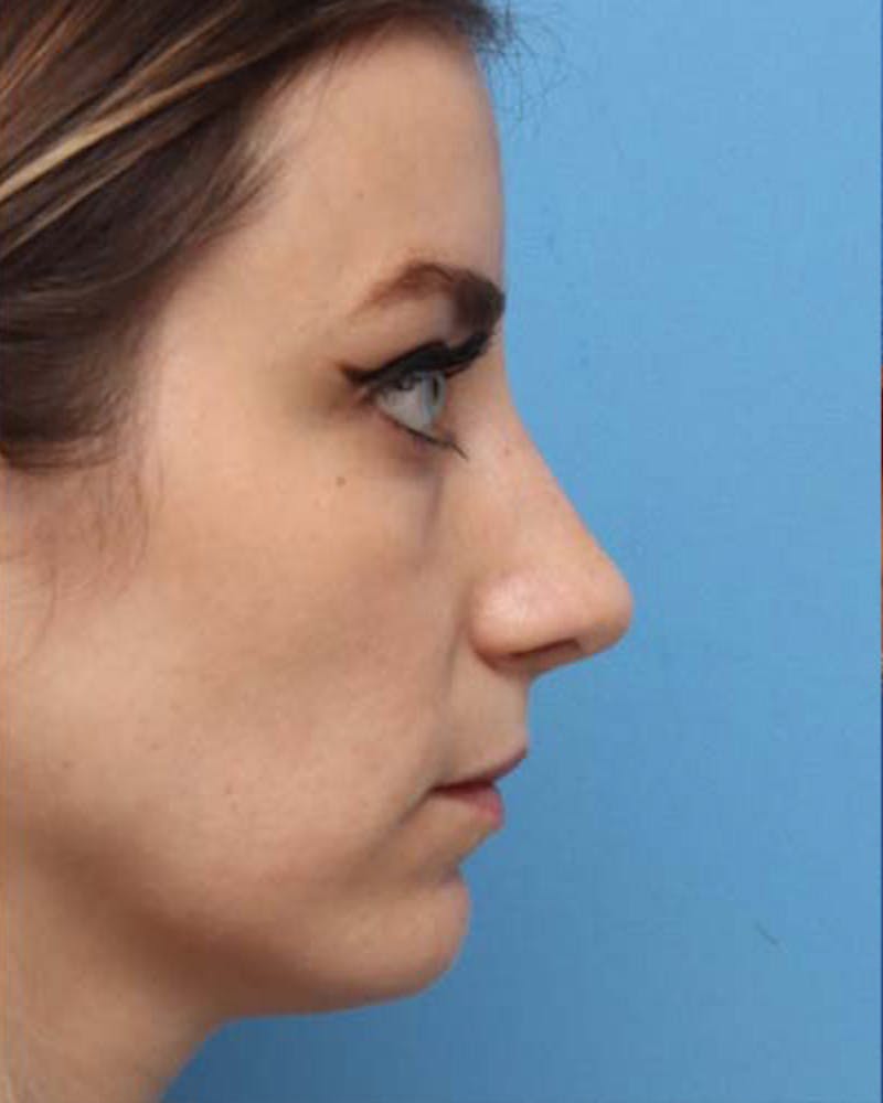 Rhinoplasty Before & After Gallery - Patient 403750 - Image 2