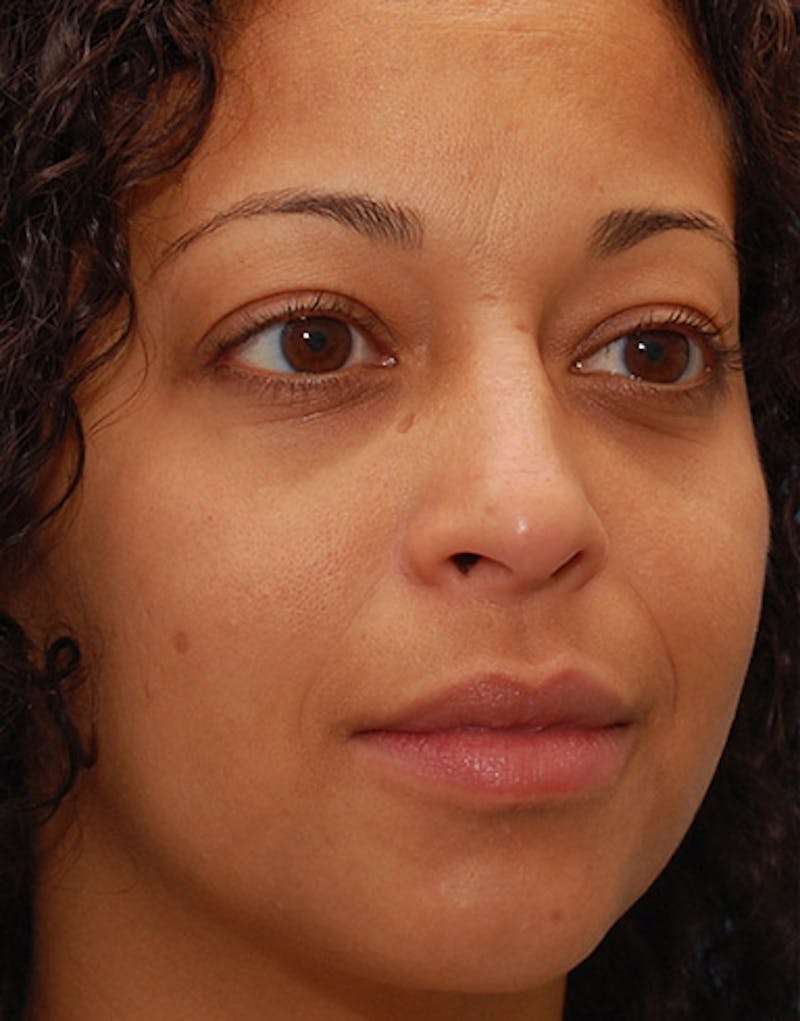 Rhinoplasty  Before & After Gallery - Patient 156471 - Image 6