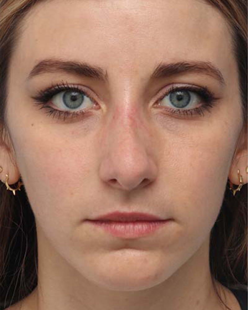 Rhinoplasty Before & After Gallery - Patient 403750 - Image 3