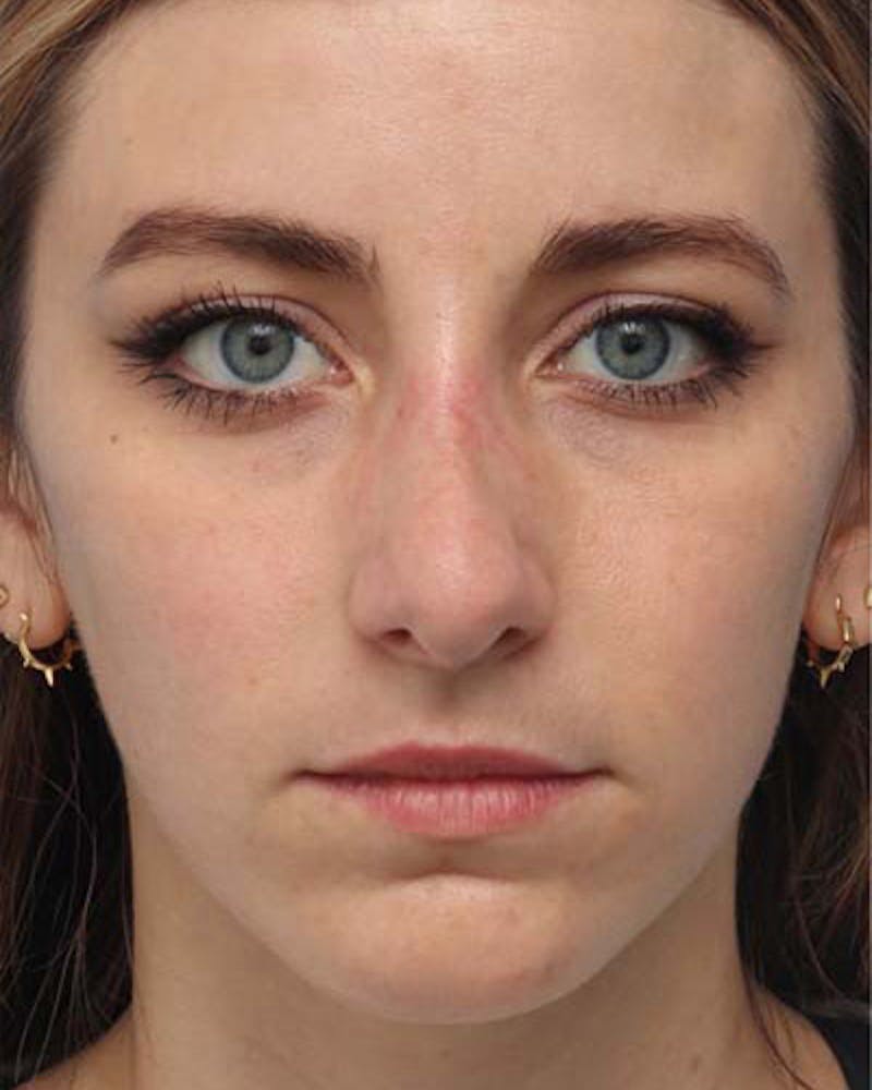 Rhinoplasty  Before & After Gallery - Patient 121265 - Image 3