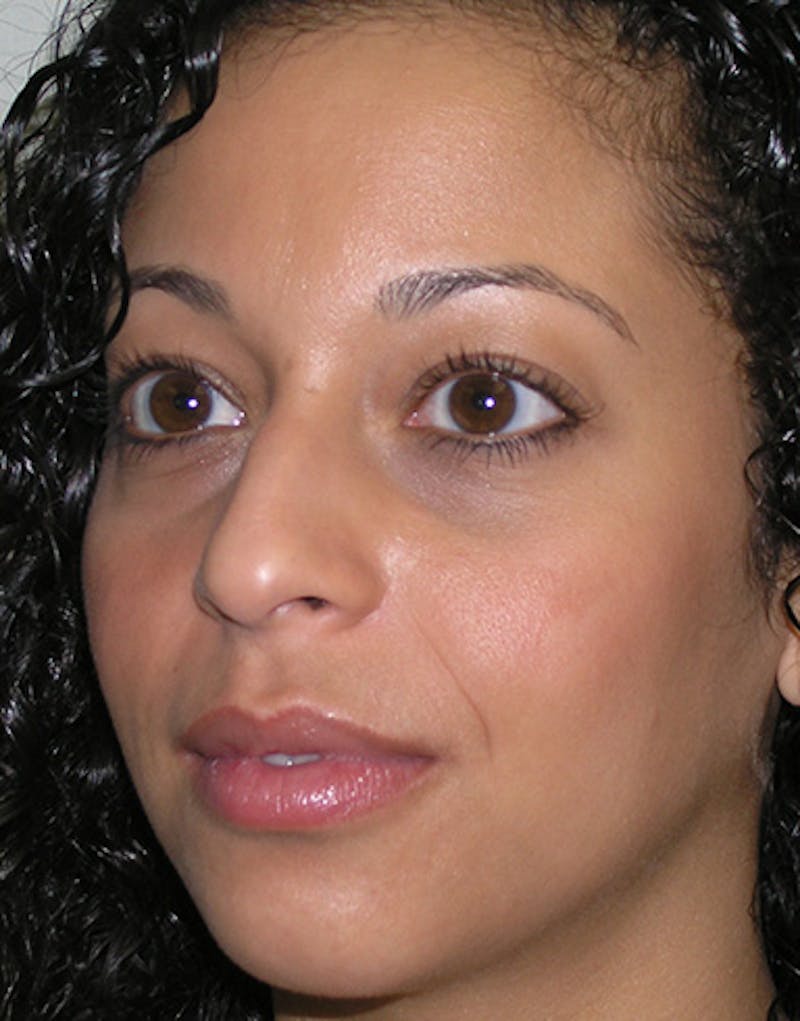 Rhinoplasty  Before & After Gallery - Patient 156471 - Image 7