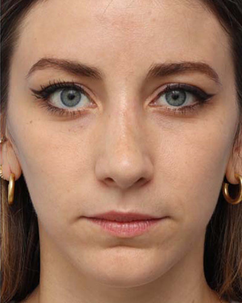 Rhinoplasty  Before & After Gallery - Patient 121265 - Image 4