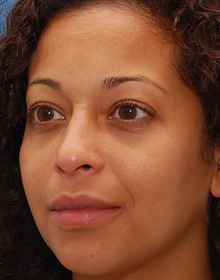 Rhinoplasty Before & After Gallery - Patient 156471 - Image 8