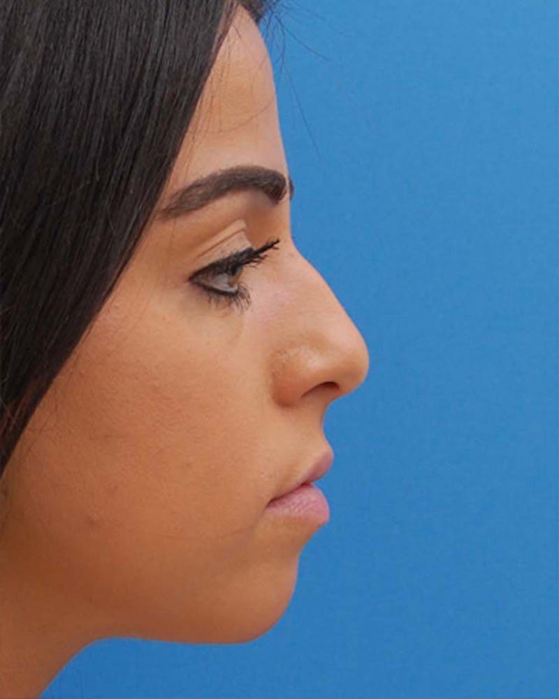 Rhinoplasty Before & After Gallery - Patient 342138 - Image 1