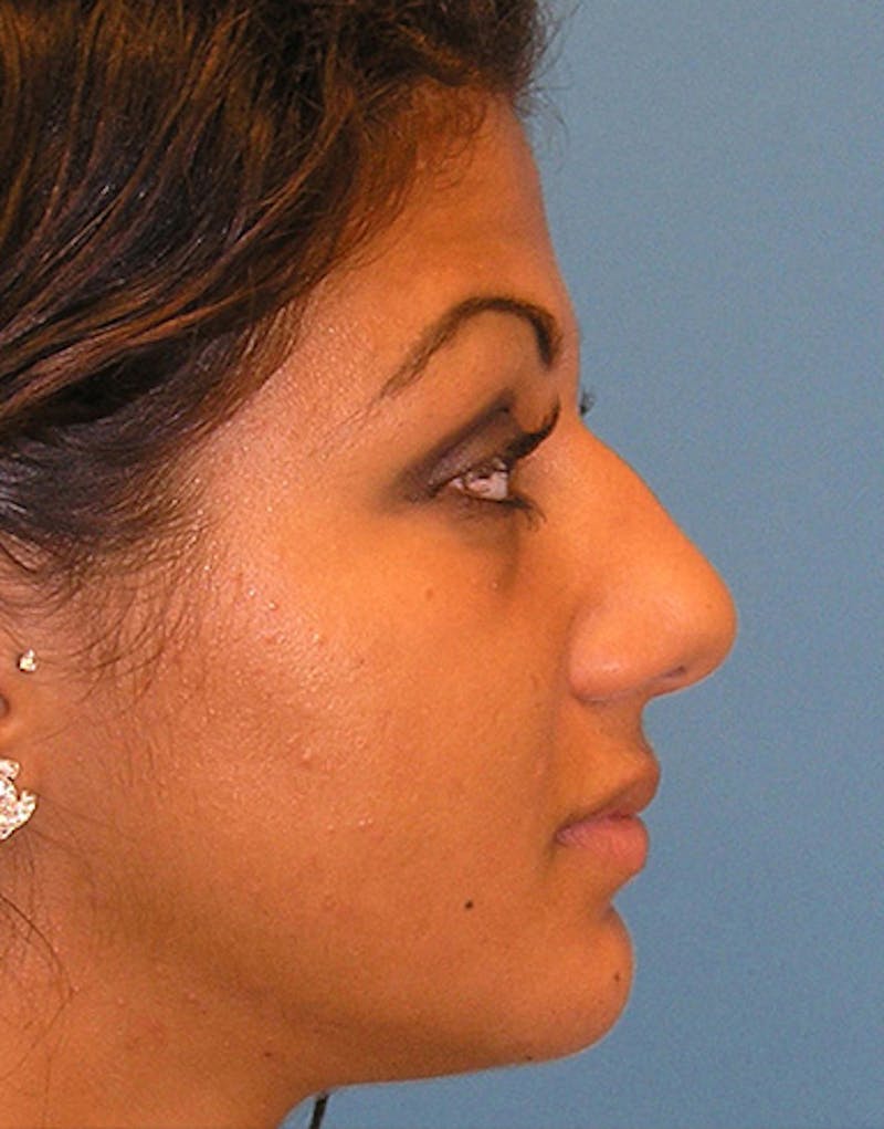 Ethnic Rhinoplasty Before & After Gallery - Patient 144045 - Image 1