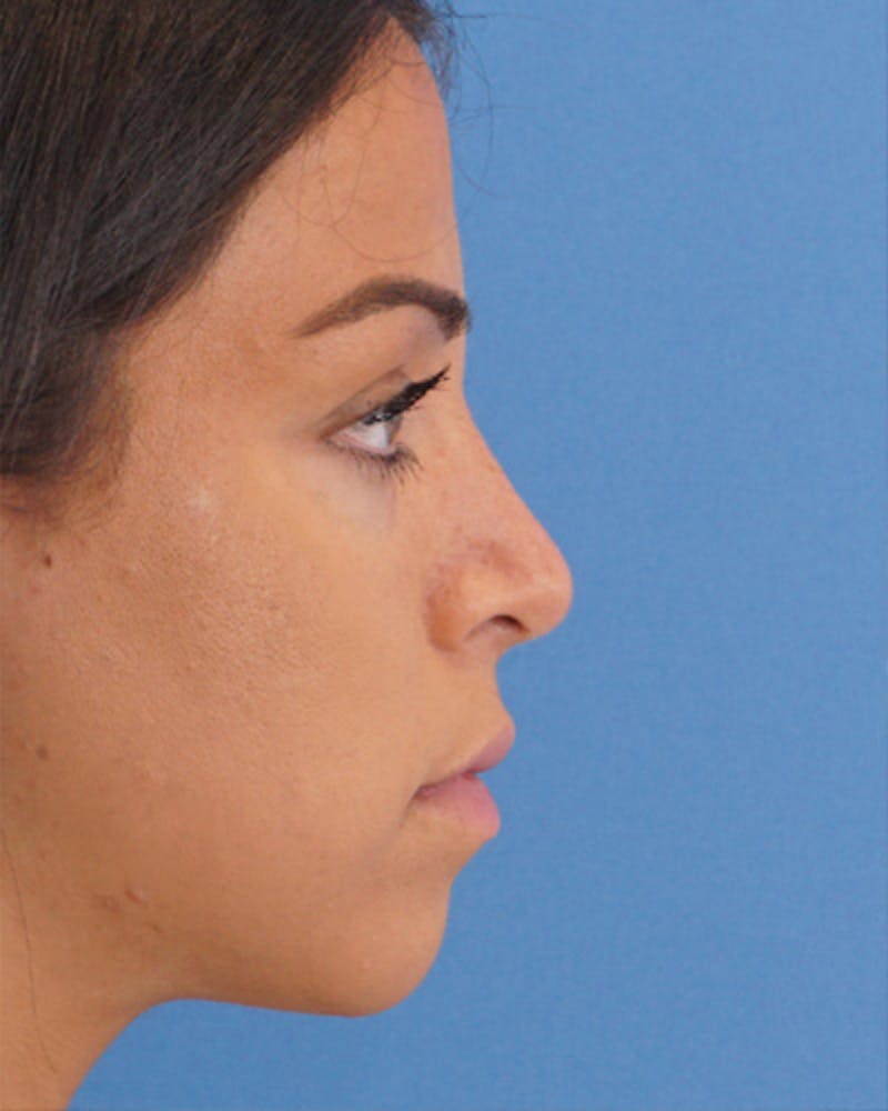 Rhinoplasty Before & After Gallery - Patient 342138 - Image 2