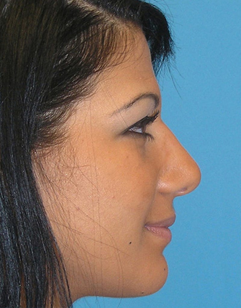 Ethnic Rhinoplasty Before & After Gallery - Patient 144045 - Image 6