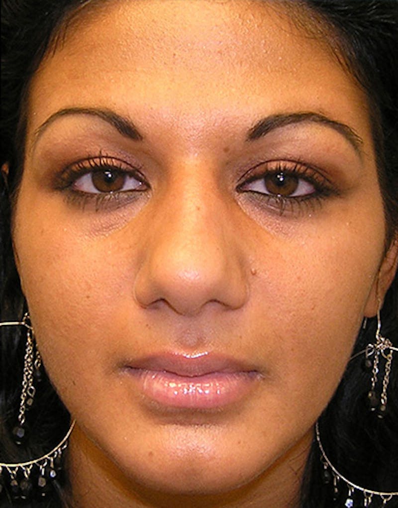 Ethnic Rhinoplasty Before & After Gallery - Patient 144045 - Image 3