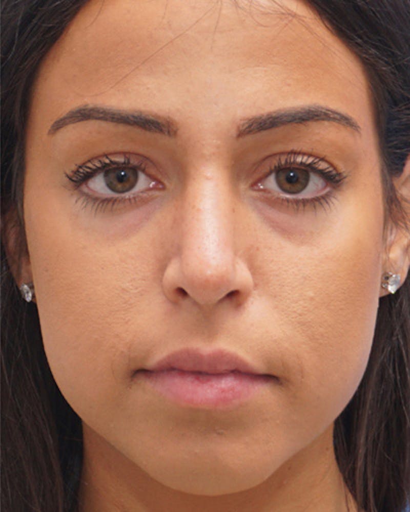Rhinoplasty Before & After Gallery - Patient 342138 - Image 4