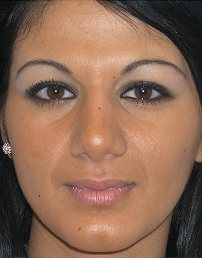 Ethnic Rhinoplasty Before & After Gallery - Patient 144045 - Image 4