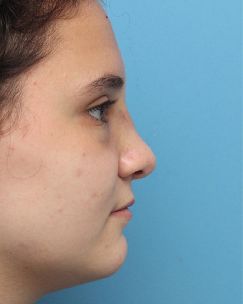 Rhinoplasty Before & After Gallery - Patient 280974 - Image 1