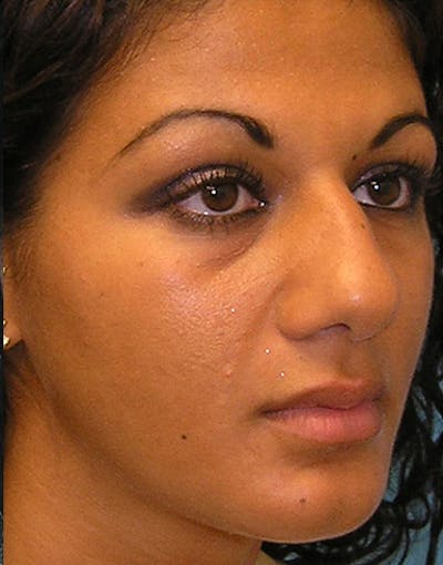 Rhinoplasty Before & After Gallery - Patient 111763 - Image 1