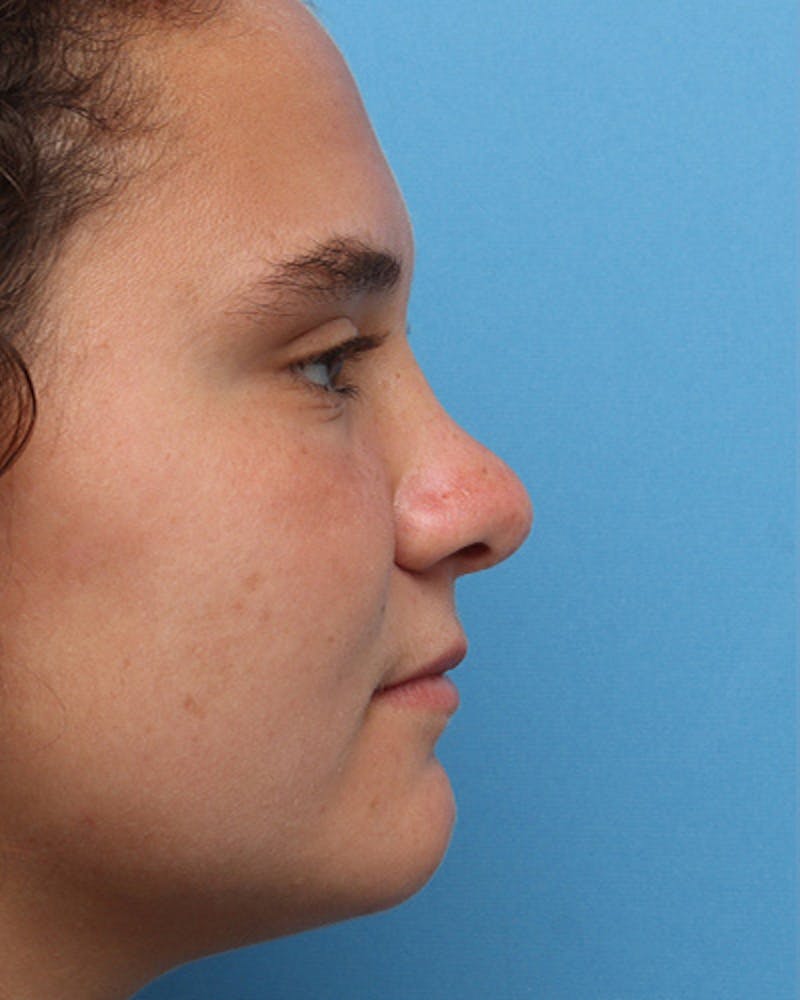 Female Rhinoplasty Before & After Gallery - Patient 280974 - Image 2