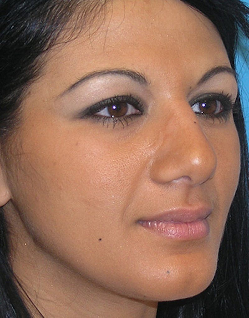 Ethnic Rhinoplasty Before & After Gallery - Patient 144045 - Image 2