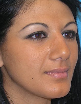Rhinoplasty Before & After Gallery - Patient 111763 - Image 2