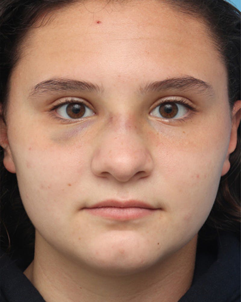 Rhinoplasty Before & After Gallery - Patient 280974 - Image 3