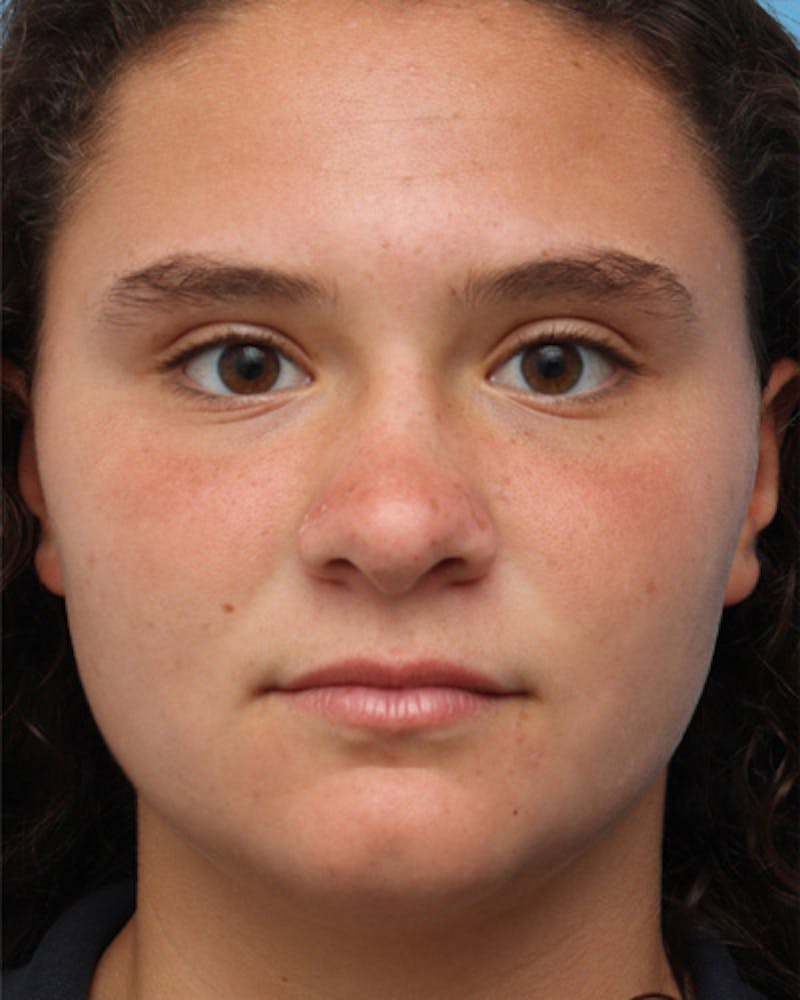 Rhinoplasty Before & After Gallery - Patient 280974 - Image 4