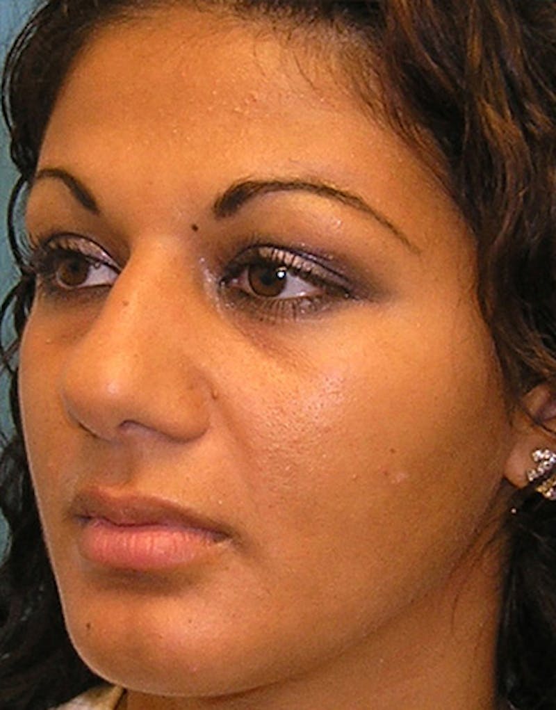 Ethnic Rhinoplasty Before & After Gallery - Patient 144045 - Image 7