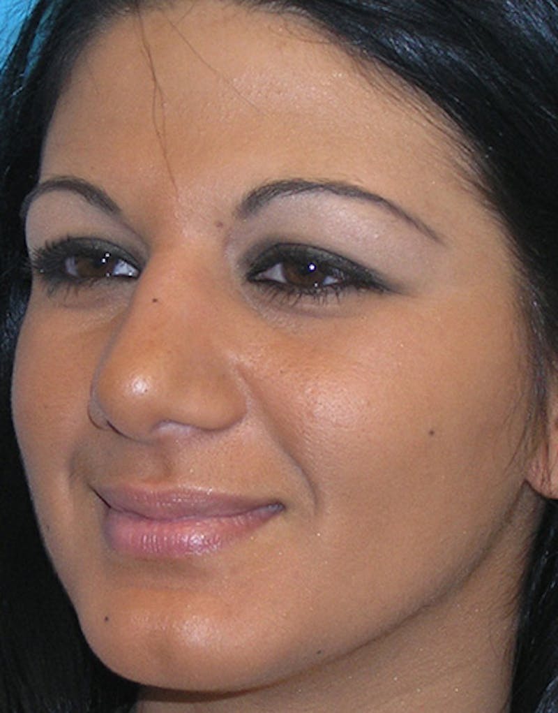 Ethnic Rhinoplasty Before & After Gallery - Patient 144045 - Image 8