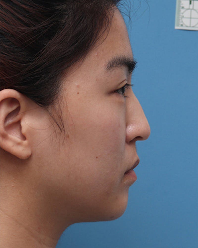 Patient W_GoJsiEQWyJrAxWYcqUcw - Ethnic Rhinoplasty Before & After Photos