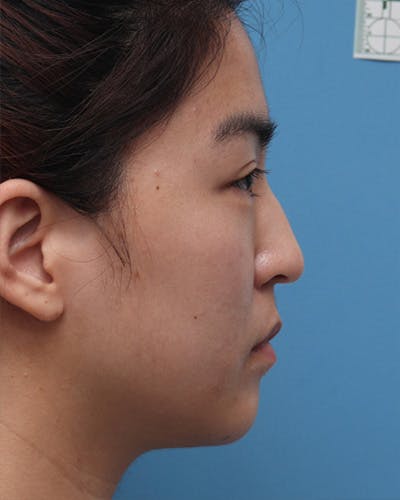 Favorite Ethnic Rhinoplasty Before & After Gallery - Patient 969633 - Image 1