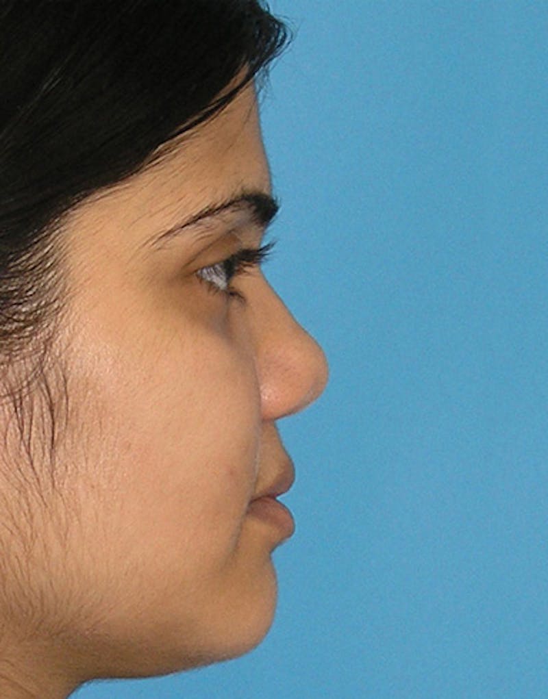 Ethnic Rhinoplasty Before & After Gallery - Patient 196662 - Image 1