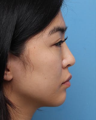 Favorite Ethnic Rhinoplasty Before & After Gallery - Patient 969633 - Image 2