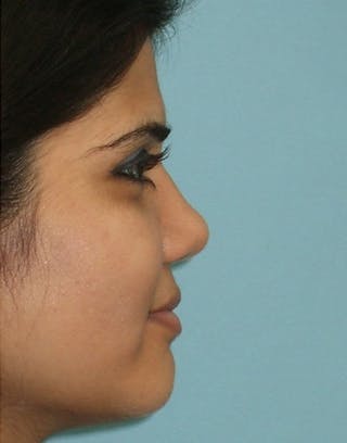 Rhinoplasty Before & After Gallery - Patient 387005 - Image 2
